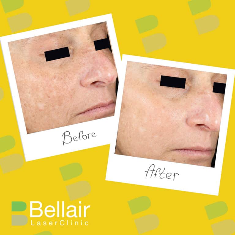 before and after picture of PRP for anti-aging