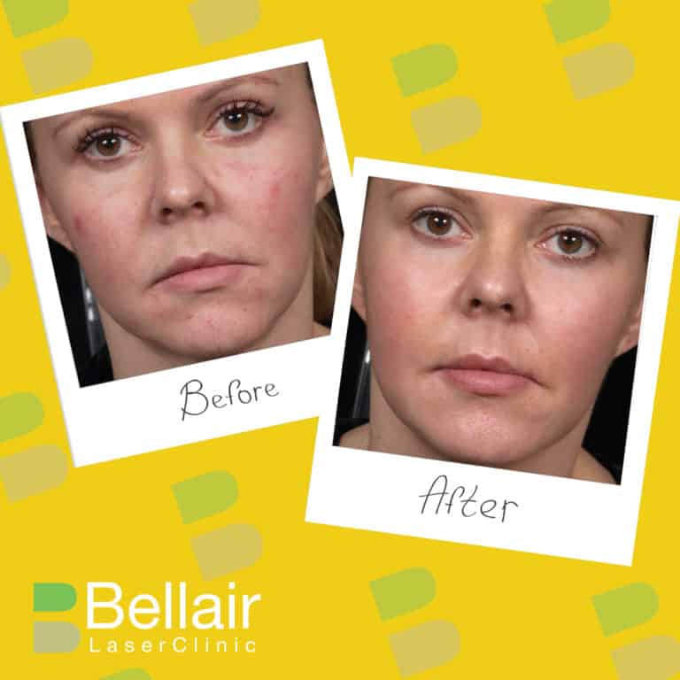 before and after picture of PRP treatments