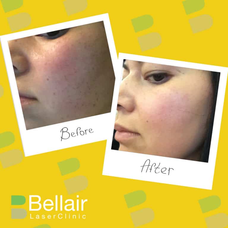 before and after picture of PRP skin rejuvenation