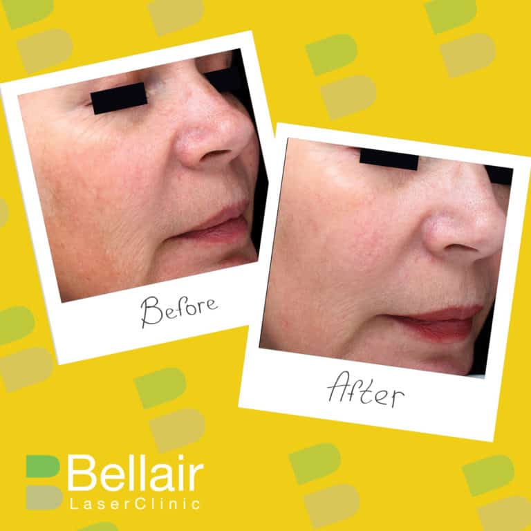 before and after picture of PRP injections