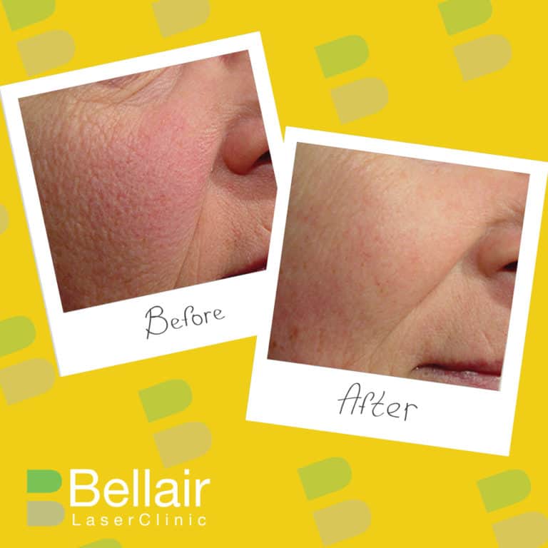 before and after picture of PRP skin repair